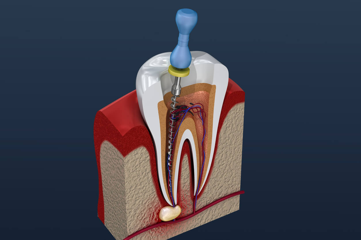 Endodoncie - ilustrační obrázek