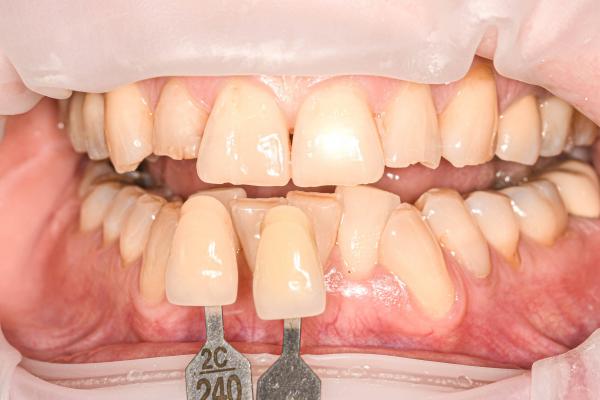 Domácí bělení zubů